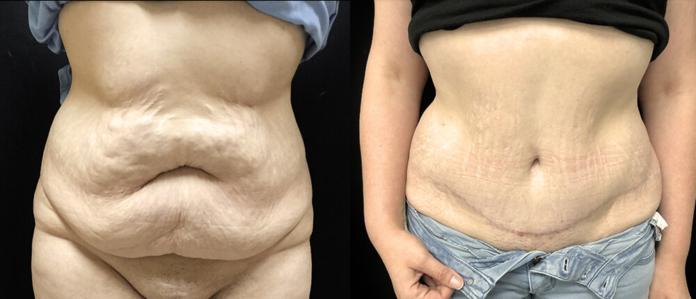 Piercing De Nombril En Silicone - 12 Pièces/6 Tailles - Pour Modelage Après Liposuccion Ou Chirurgie Abdominale