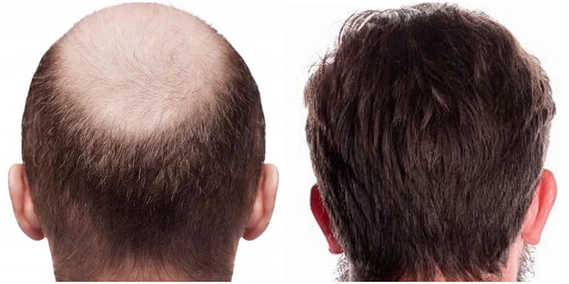 prezzo trapianto di capelli Turchia