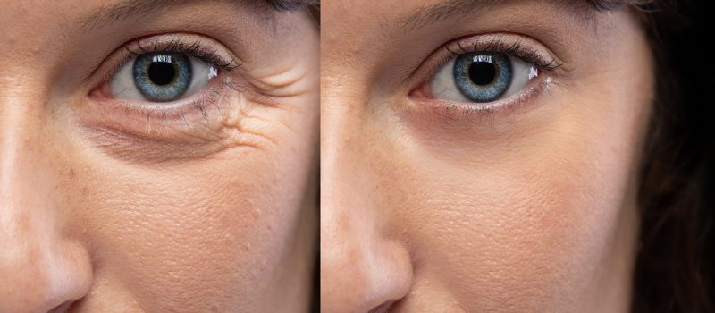 avant-apres-rajeunissement-contour-yeux
