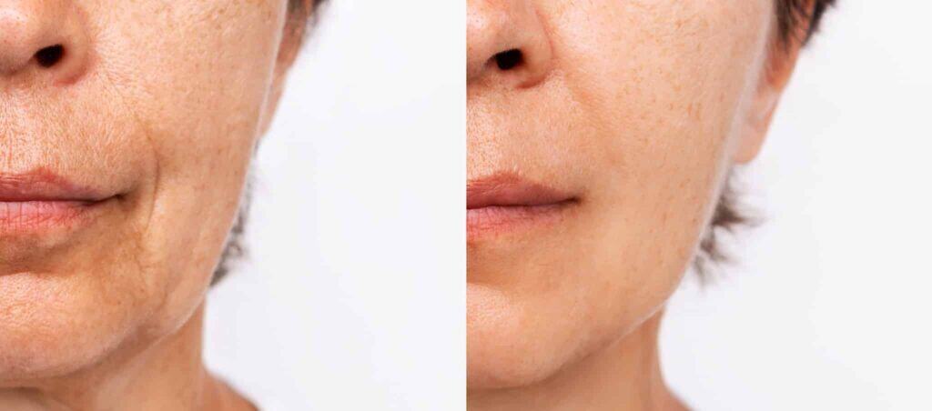 Avant / Après Deep Plane Facelift