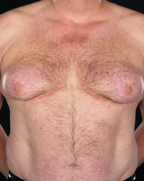 chirurgie gynecomastie Istanbul Turquie